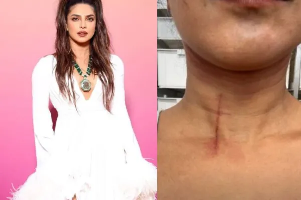 Priyanka Chopra injury 